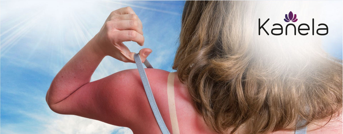 Was man gegen Sonnenbrand tun kann