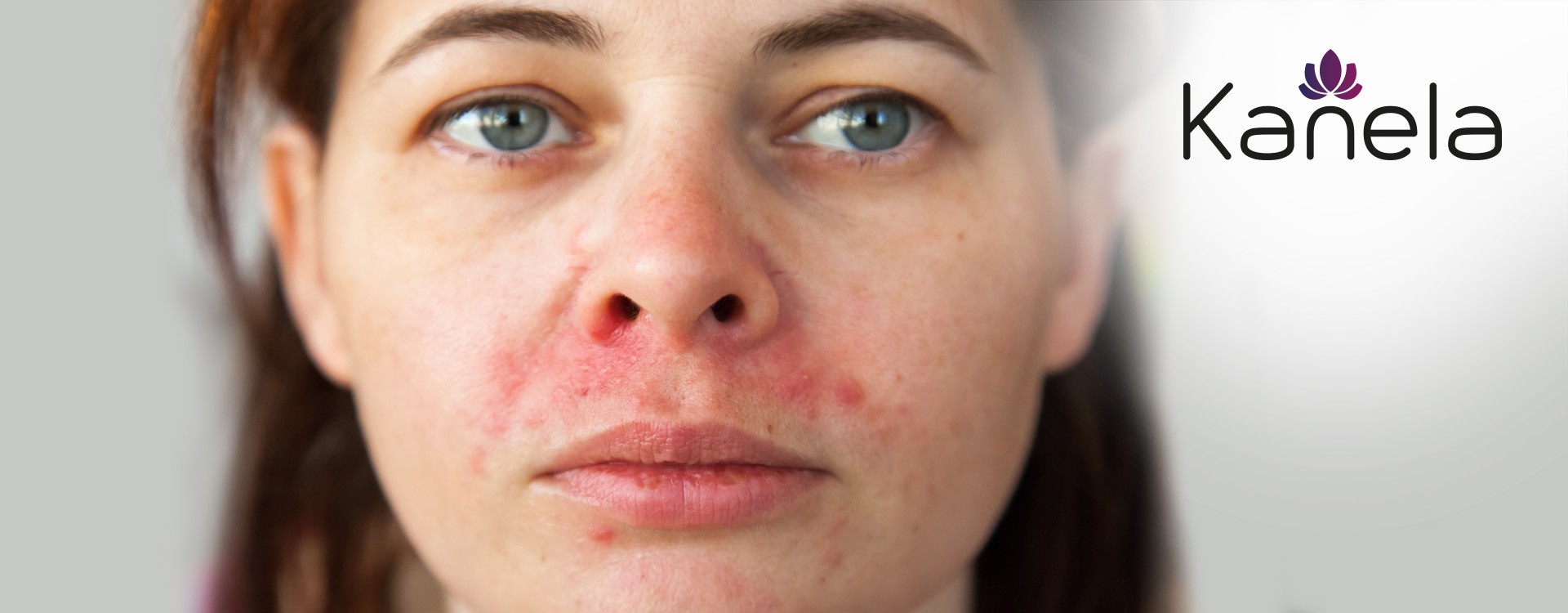 What can be done about perioral dermatitis?