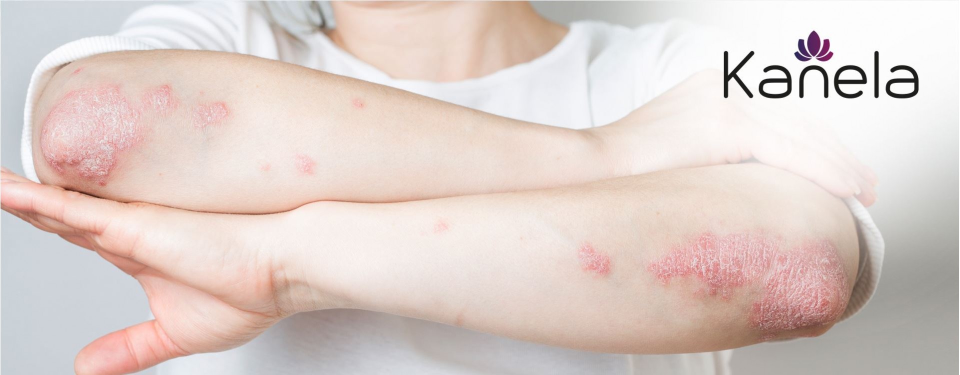 What helps against psoriasis?