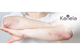 What helps against psoriasis?